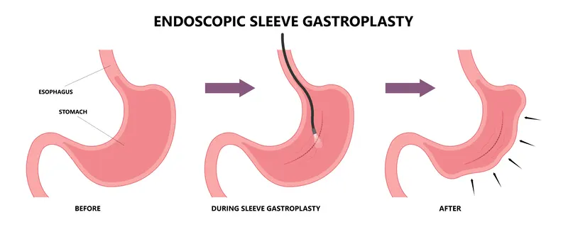 Endoscopic-Sleeve-Gastrectomy